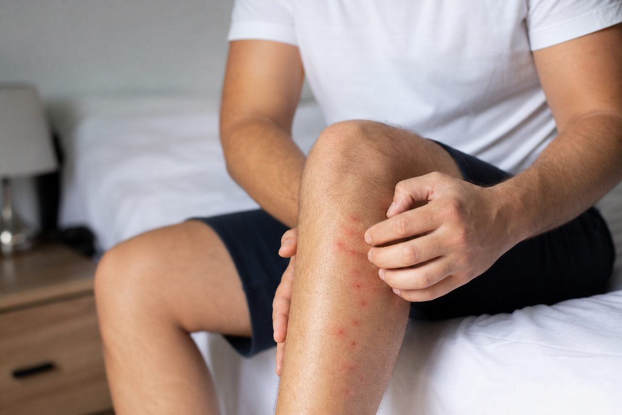 Comprendre les raisons des piqûres de puces sur l’homme : explications et réactions