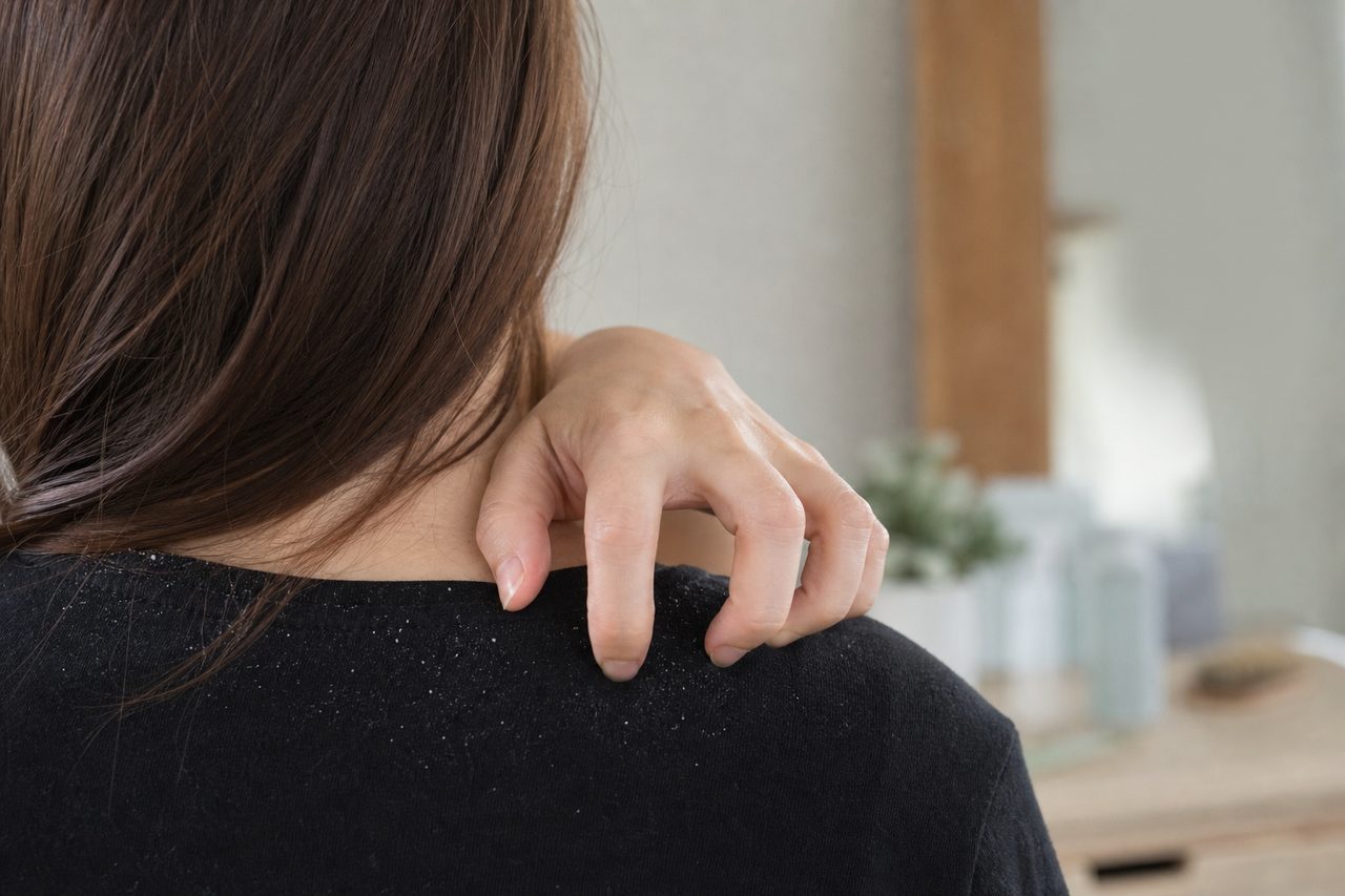 Démangeaisons et gêne: comprendre pourquoi j’ai des pellicules et comment trouver des solutions